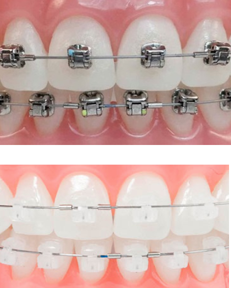 brackets de autoligado lilident