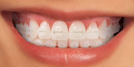 brackets esteticos lilident